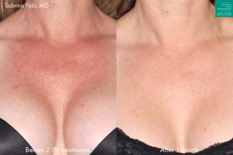 Intense pulsed light (IPL) therapy to rejuvenate the skin of the chest of a female patient by Dr. Fabi. Treatment removes discoloration for smoother, clearer skin.