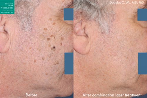 Sun Damage Brown Spot Removal San Diego Ca Clderm