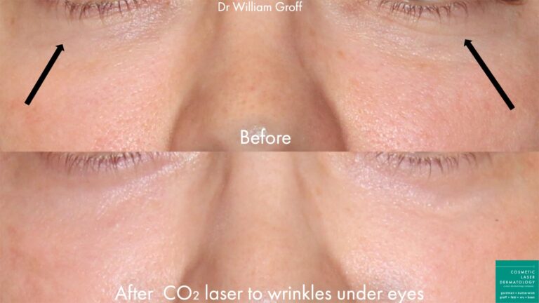 CO2 laser to rejuvenate skin underneath the eyes of a female patient by Dr. Groff. Treatment erases fine lines to create a refreshed appearance.