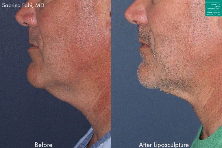 Neck liposuction to remove submental fat from a male patient by Dr. Fabi.