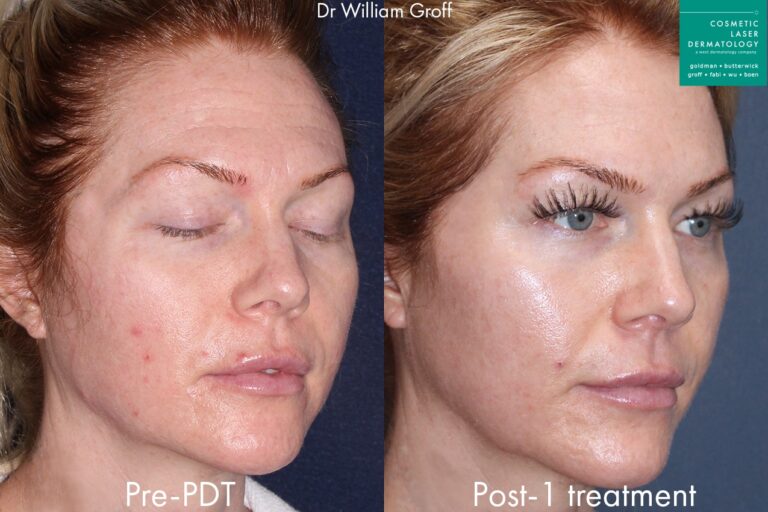 Photodynamic therapy to address breakouts and rejuvenate the skin by Dr. Groff. After treatment, skin is clearer with a visible reduction in red spots.
