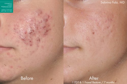 Fraxel and photodynamic therapy to treat acne on a male patient by Dr. Fabi. After treatments, skin is visibly clearer.