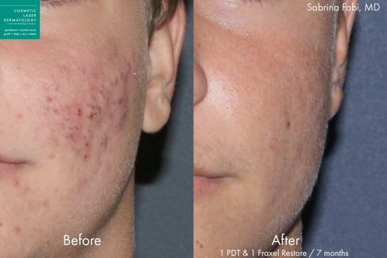 Fraxel and photodynamic therapy to treat acne on a male patient by Dr. Fabi. After treatments, skin is visibly clearer.