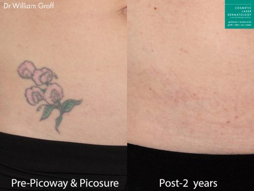 PiQo4 Laser Tattoo Removal  San Diego CA  CLDerm