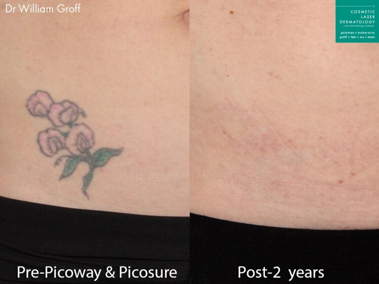 PicoSure and PicoWay lasers used to remove a tattoo. Two years later, ink is nearly completely eliminated.