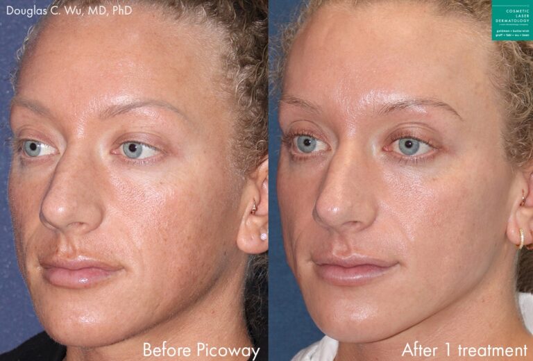 PicoWay laser to remove hyperpigmentation and treat sun damage by Dr. Wu. Treatment eliminates hyperpigmentation to create clearer, fresher skin.