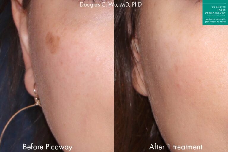 PicoWay laser to remove brown spot by Dr. Wu. Treatment eliminates hyperpigmentation to create clearer, fresher skin.