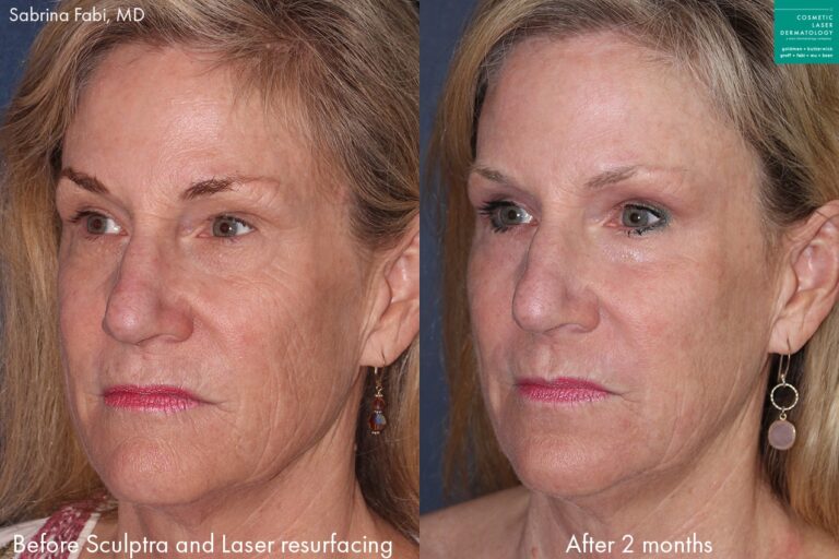 Laser resurfacing and Sculptra to rejuvenate the face of a female patient by Dr. Fabi. After treatment, skin is smoother and firmer, and eyes look refreshed.