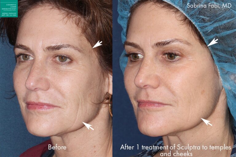 Sculptra to augment cheeks and temples of a female patient by Dr. Fabi. After treatment areas are fuller and more youthful.