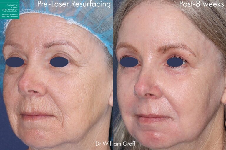 Take 10 treatment with laser resurfacing to rejuvenate the skin by Dr. Groff. Treatment reduces appearance of lines and creates firmer, smoother skin.