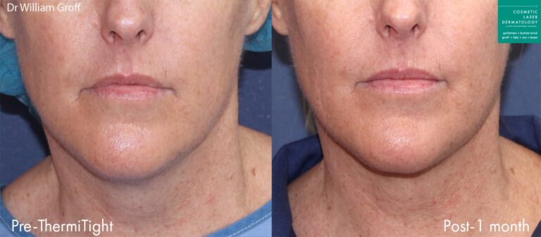 ThermiTight and microlipo for chin contouring by Dr. Groff. After treatment, jawline is slimmer and better defined.