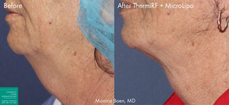 ThermiRF and microlipo to remove submental fat and tighten the skin of a female patient by Dr. Boen. Treatment removes fat pocket and creates better definition along the jawline.