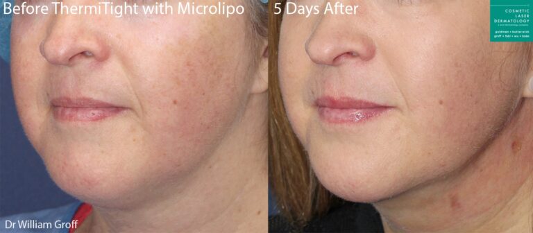 ThermiTight and microliposuction for chin contouring on a female patient by Dr. Groff. Procedure eliminates submental fat and improves jaw definition.