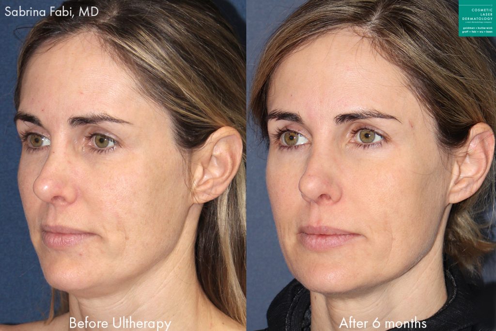 Ultherapy to tighten skin and improve facial contour of a female patient by Dr. Fabi. Disclaimer: Results may vary from patient to patient. Results are not guaranteed.