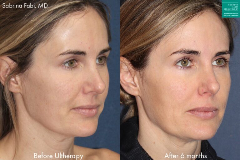 Ulthera to tighten skin and improve the facial contour of a female patient by Dr. Fabi. After treatment, skin is smoother and jawline is more defined.