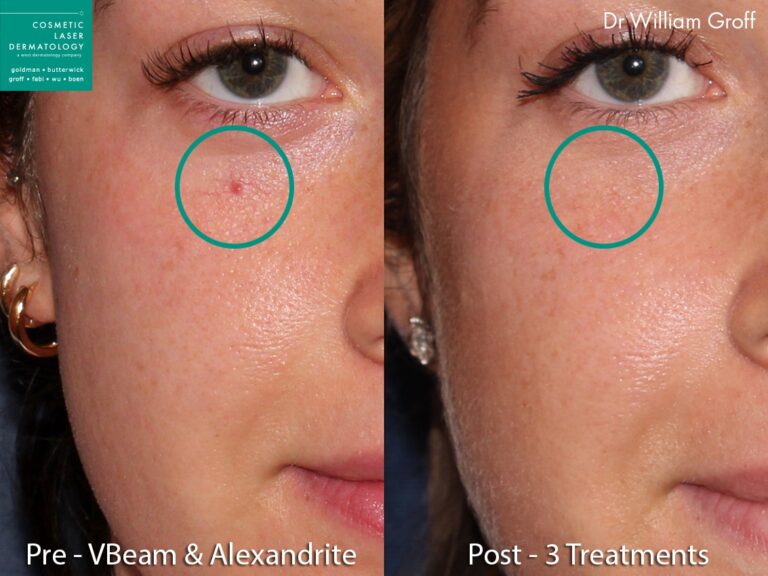 Vbeam and Alexandrite lasers to remove spiderangioma on a female patient by Dr. Groff. Treatment eliminates red bump from patient's cheek.