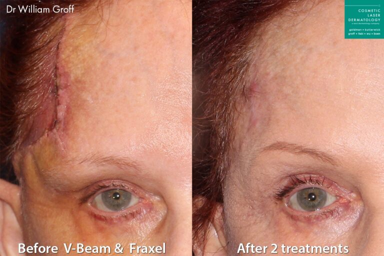 Vbeam and Fraxel to treat forehead scar on female patient. Treatment significantly reduces appearance of scar, making it nearly unnoticeable.