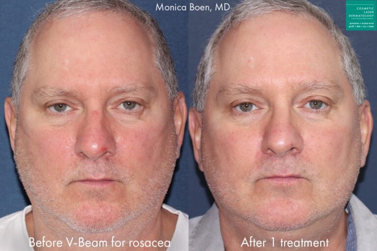 Vbeam laser used to reduce rosacea symptoms on the cheeks of a male patient by Dr. Boen. After treatment, cheeks are visibly less red.