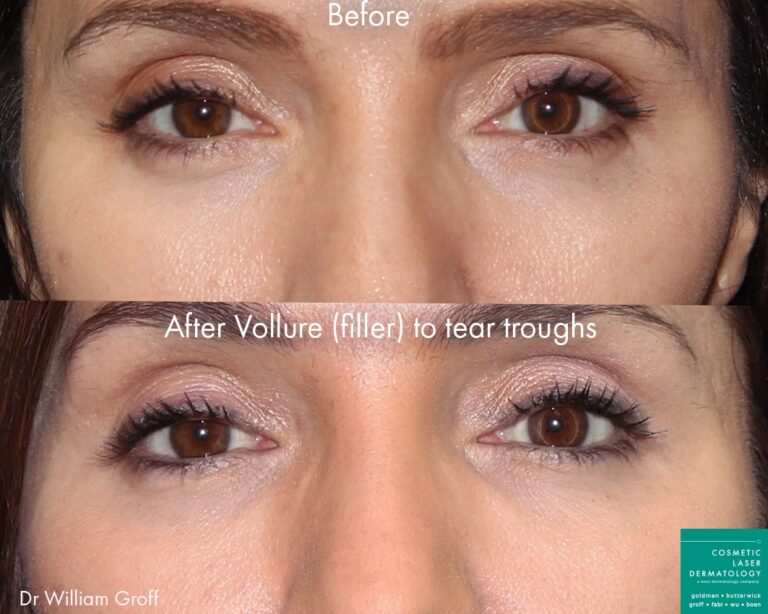 Vollure filler injected into tear troughs to rejuvenate the under-eye area by Dr. Groff. After treatment, lines are diminished and eyes look refreshed.