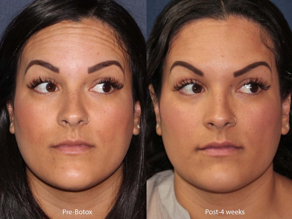 cosmetic laser dermatology botox wrinkle treatment in san diego, ca before and after