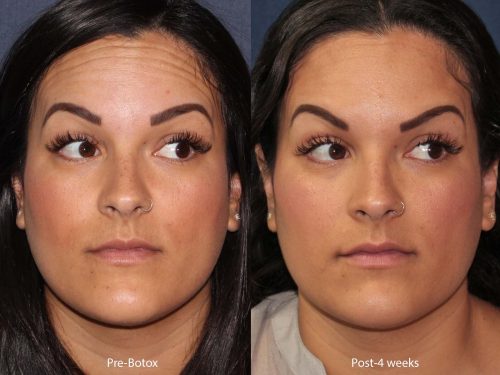 botox wrinkle treatment in san diego, ca