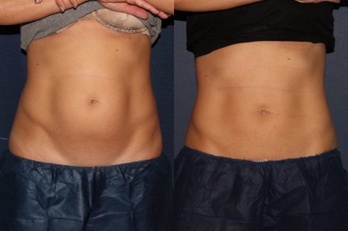 coolsculpting in san diego, ca