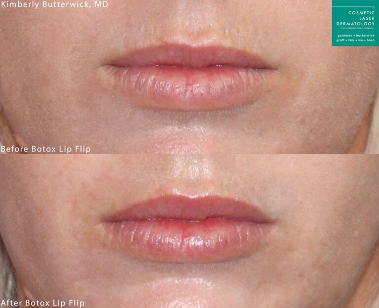 Botox lip lift to augment and lift the lips by Dr. Butterwick. Treatment creates fuller lips and a more youthful appearance.