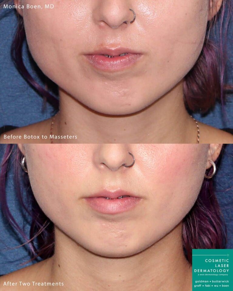 Botox injections in the masseter muscle to slim the jawline by Dr. Boen. After treatment, jaw is narrower and less square.