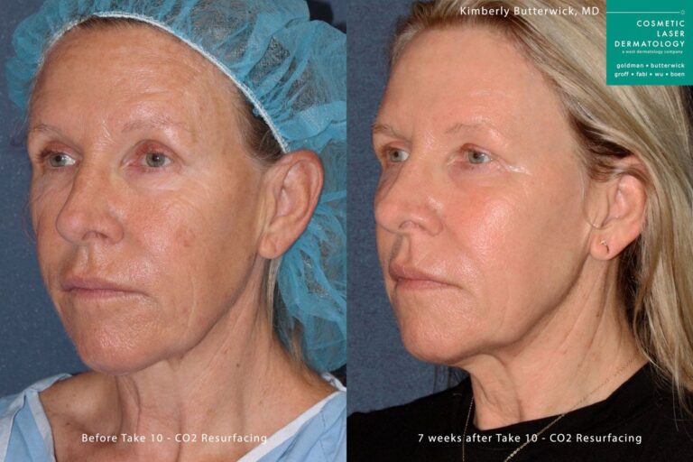 Fraxel repair for skin rejuvenation by Dr. Butterwick. Treatment creates smoother, refreshed skin and a more youthful appearance.