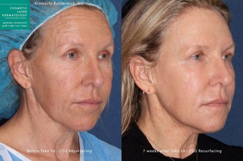 Fraxel repair for skin rejuvenation by Dr. Butterwick. Treatment creates smoother, refreshed skin and a more youthful appearance san diego ca