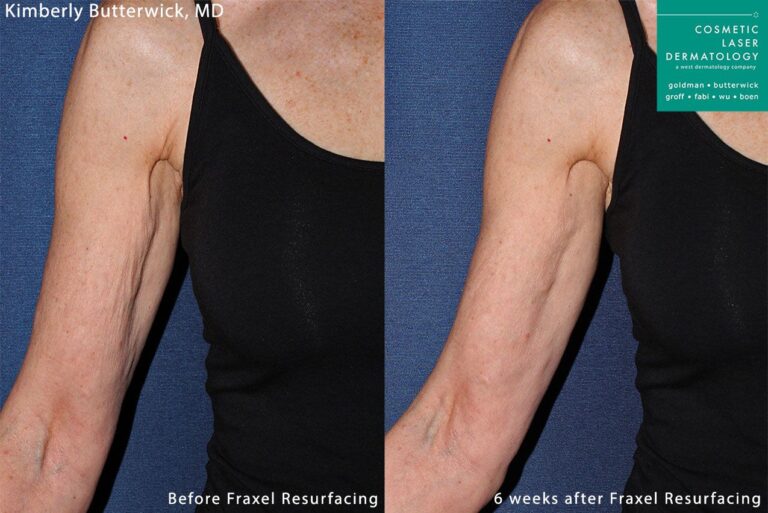 Fraxel and Radiesse to rejuvenate the upper arm by Dr. Butterwick. Treatments leave skin firmer and less crepey.