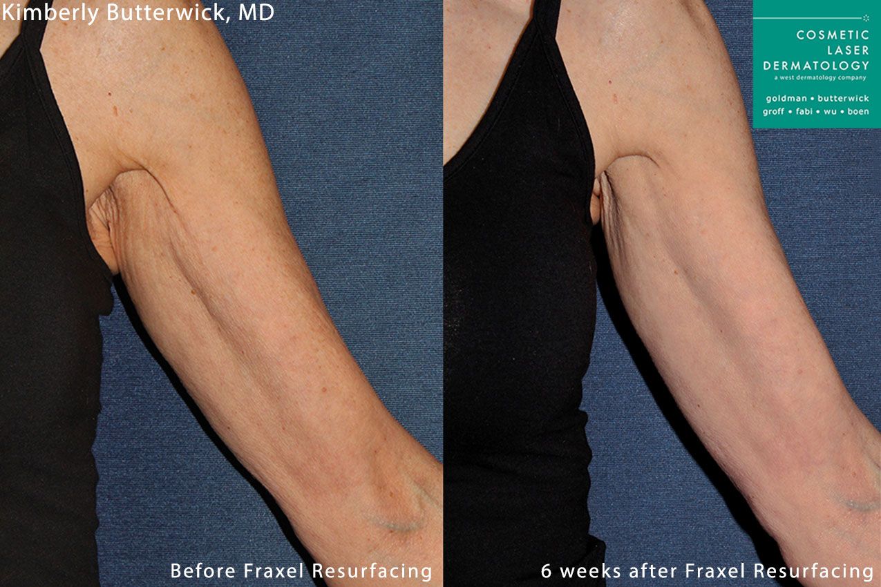 Fraxel and Radiesse to rejuvenate the upper arm by Dr. Butterwick. Treatments leave skin firmer and less crepey.