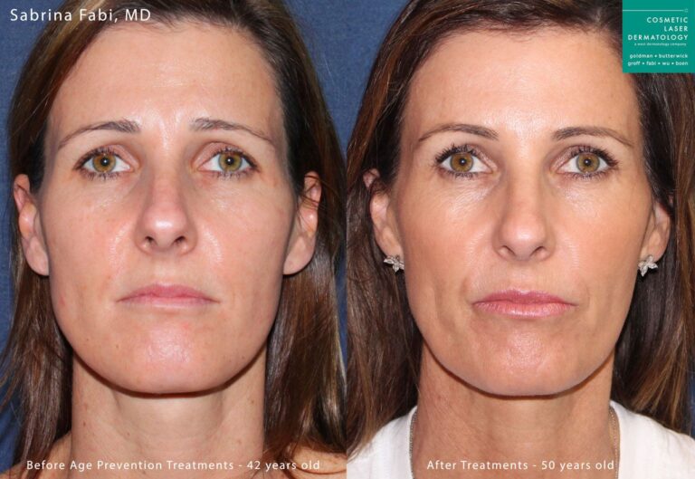 IPL and injectables to rejuvenate the face by Dr. Fabi. Treatments restores youthful volume and smooths away some lines for a refreshed appearance.