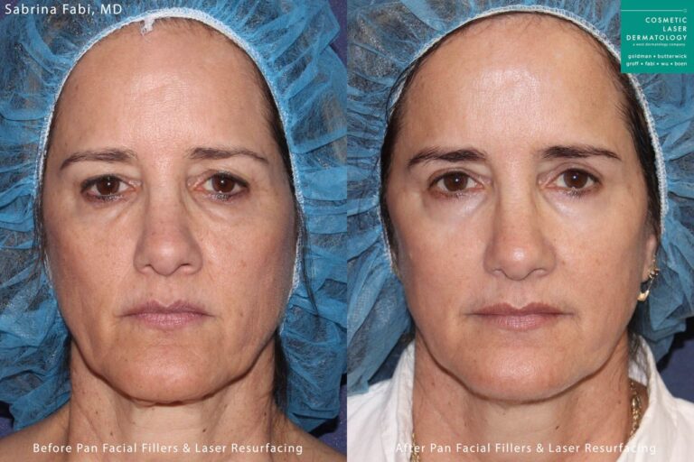 Laser resurfacing and fillers for rejuvenation by Dr. Fabi. Treatment refreshes the eyes and creates a smoother skin surface.