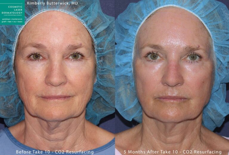 Laser resurfacing to rejuvenate the skin by Dr. Butterwick. After treatment, skin is smoother and lines are visibly reduced.
