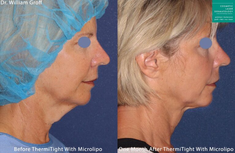 Micro-lipo and ThermiTight for neck and chin contouring by Dr. Groff. After procedure, submental fat and turkey neck are gone and jaw is more defined.