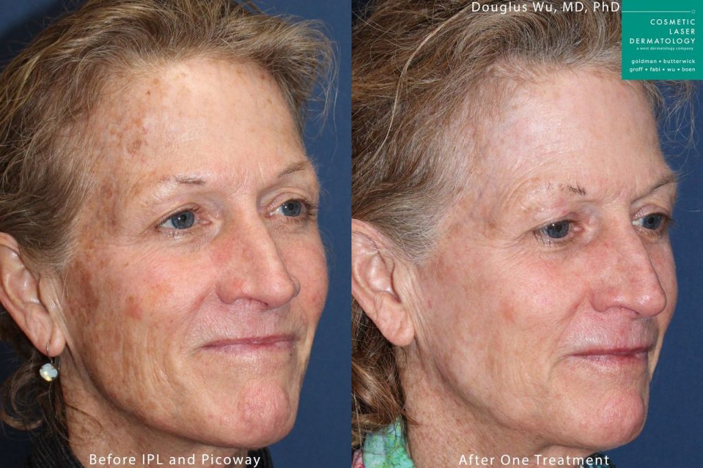 What To Expect Before During And After Ipl Photofacial Treatment Cosmetic Laser Dermatology