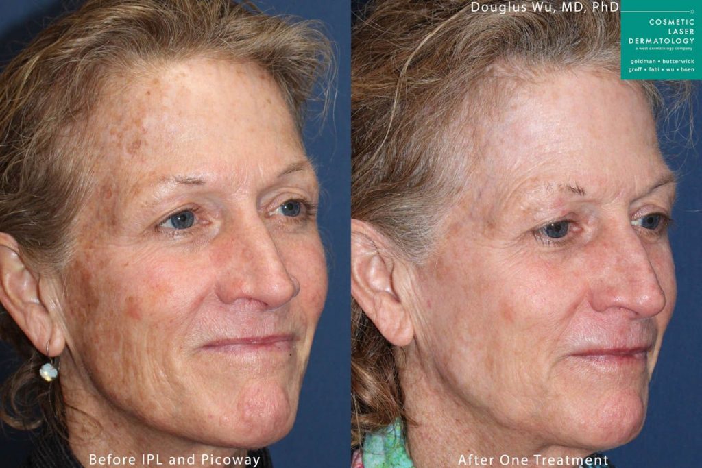 PicoWay and IPL to rejuvenate the skin by Dr. Wu. After treatment, pigmentation is reduces and skin looks refreshed.