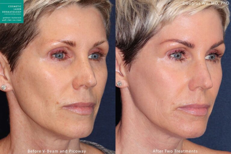 PicoWay laser to treat sun damage by Dr. Wu. Treatment produces visible reduction in hyperpigmentation and brown spots.