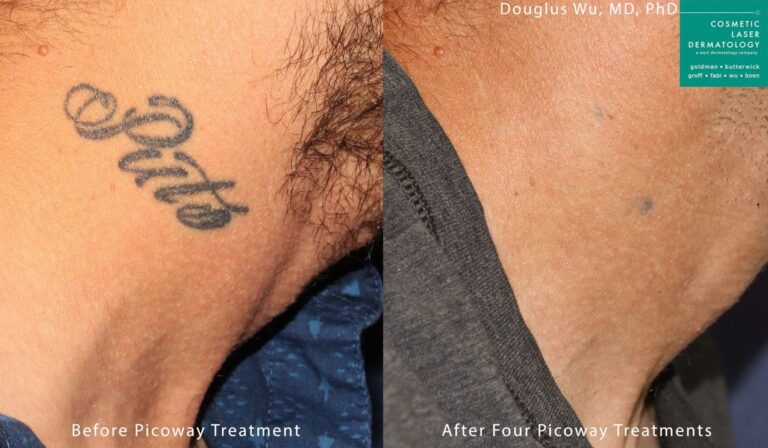 PicoWay laser used to remove a tattoo on the neck by Dr. Wu. After a series of treatments, ink is nearly completely eliminated.