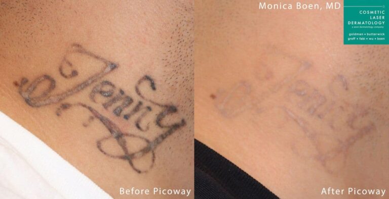 PicoWay laser to remove neck tattoo by Dr. Boen. Treatments significantly reduce the appearance of the ink.