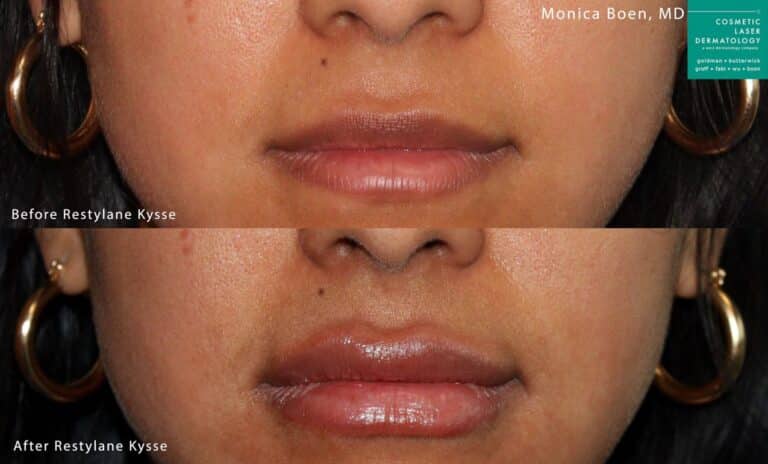 Restylane Kysse to plump up the lips by Dr. Boen. After injections, lips are fuller and more shapely.