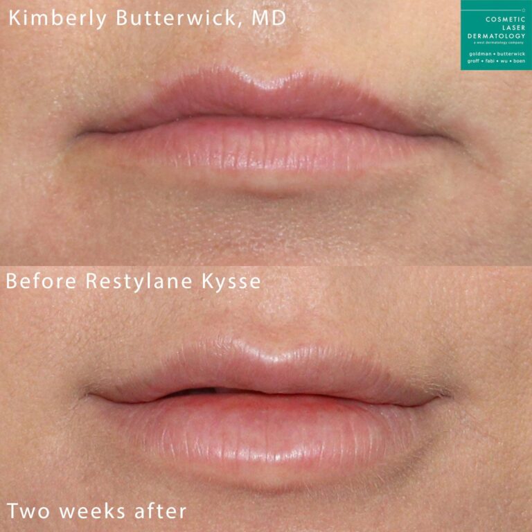 Restylane Kysse to augment the lips by Dr. Butterwick. Treatment creates fuller, shapelier lips.