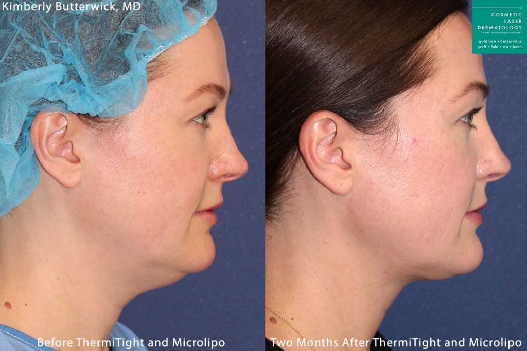 Micro-lipo and ThermiTight for neck and chin contouring by Dr. Butterwick. After procedure, submental is gone and jaw is more defined san diego ca