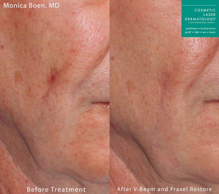 Fraxel Restore and Vbeam to treat skin redness and rejuvenate the skin. After treatment red marks are gone and skin is smoother.