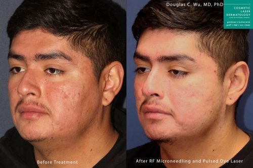 Vbeam and RF microneedling to treat acne scarring by Dr. Wu. After treatment, skin is smoother with a visible reduction in scars.