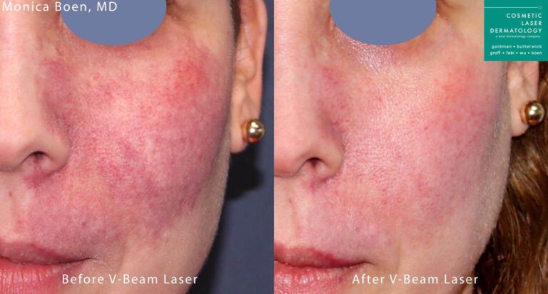 Vbeam to treat port wine stain by Dr. Boen. After treatment, birthmark is much less visible.
