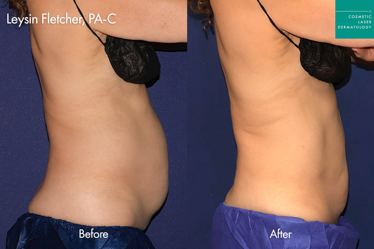 before and after coolsculpting in san diego
