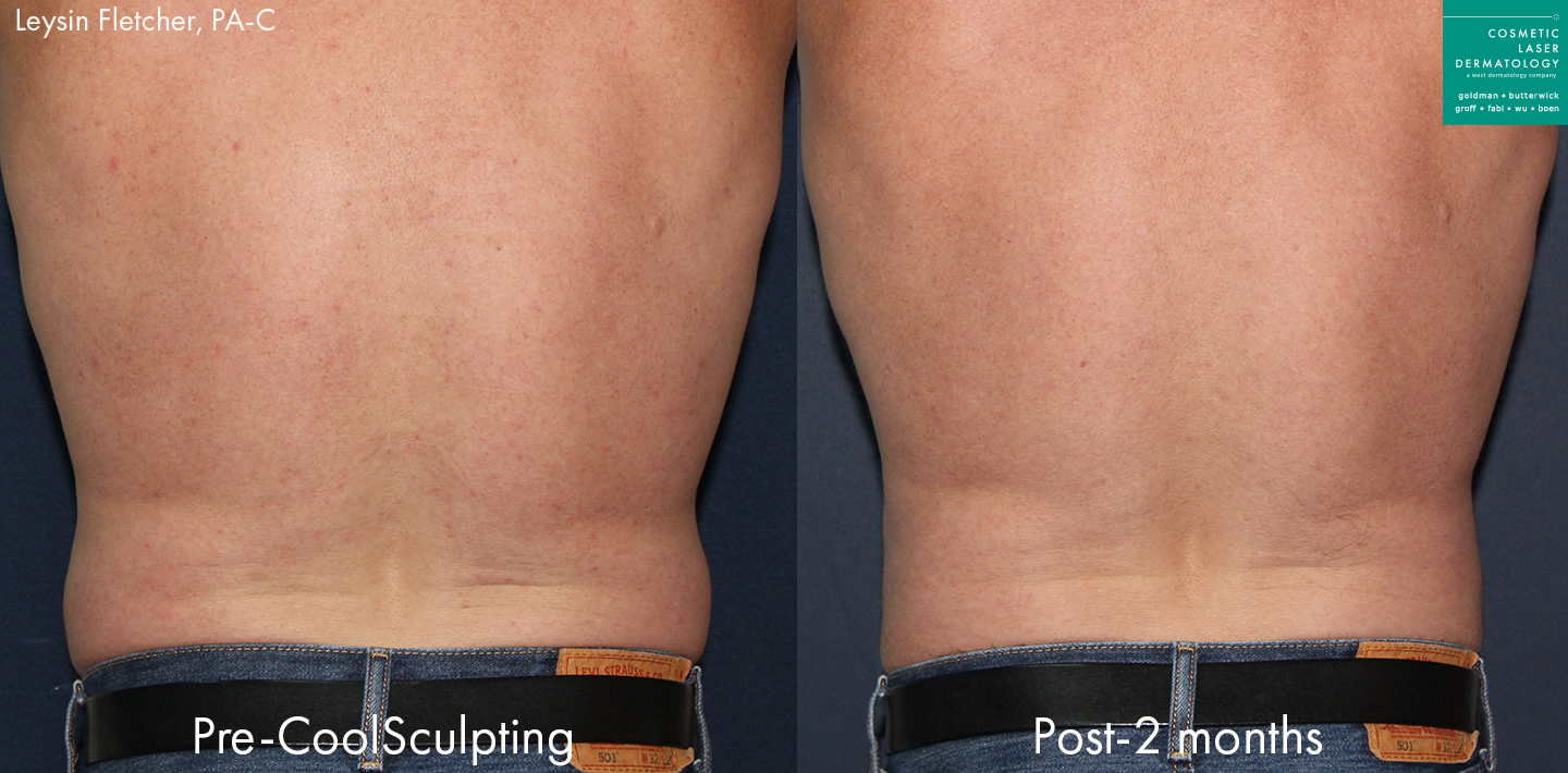 CoolSculpting vs. RF Body Contouring - The Laser Cafe