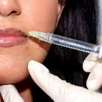 Image showing a woman getting a lip filler injection, San Diego, CA.